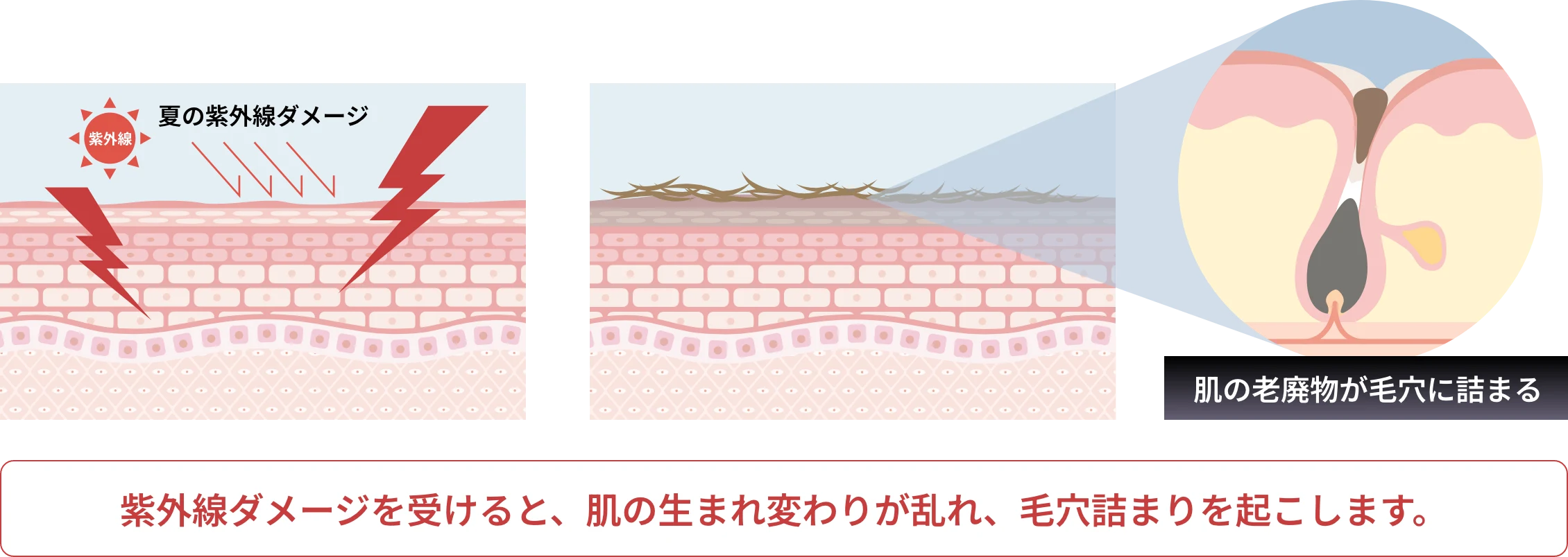 ダーマペン