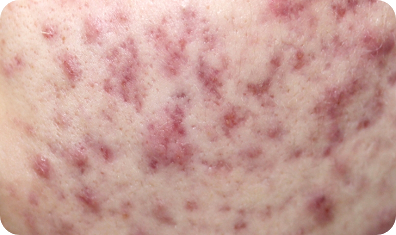 皮膚の常在菌であるアクネ菌の繁殖が原因で起こる尋常性ざ瘡(ニキビ)