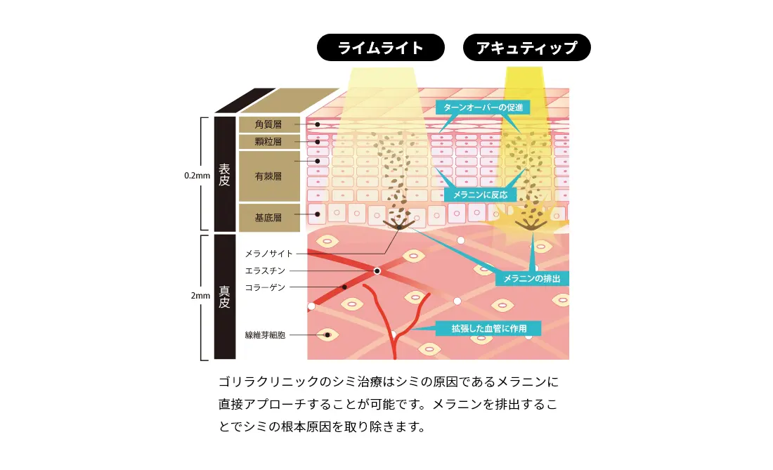 ゴリラクリニックのシミ治療はシミの原因であるメラニンに直接アプローチすることが可能です。メラニンを排出することでシミの根本原因を取り除きます。