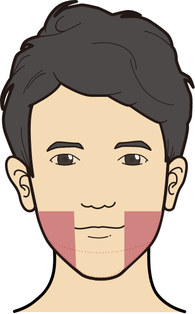 脂肪溶解ハイフの施術対象範囲（頬・アゴ下）