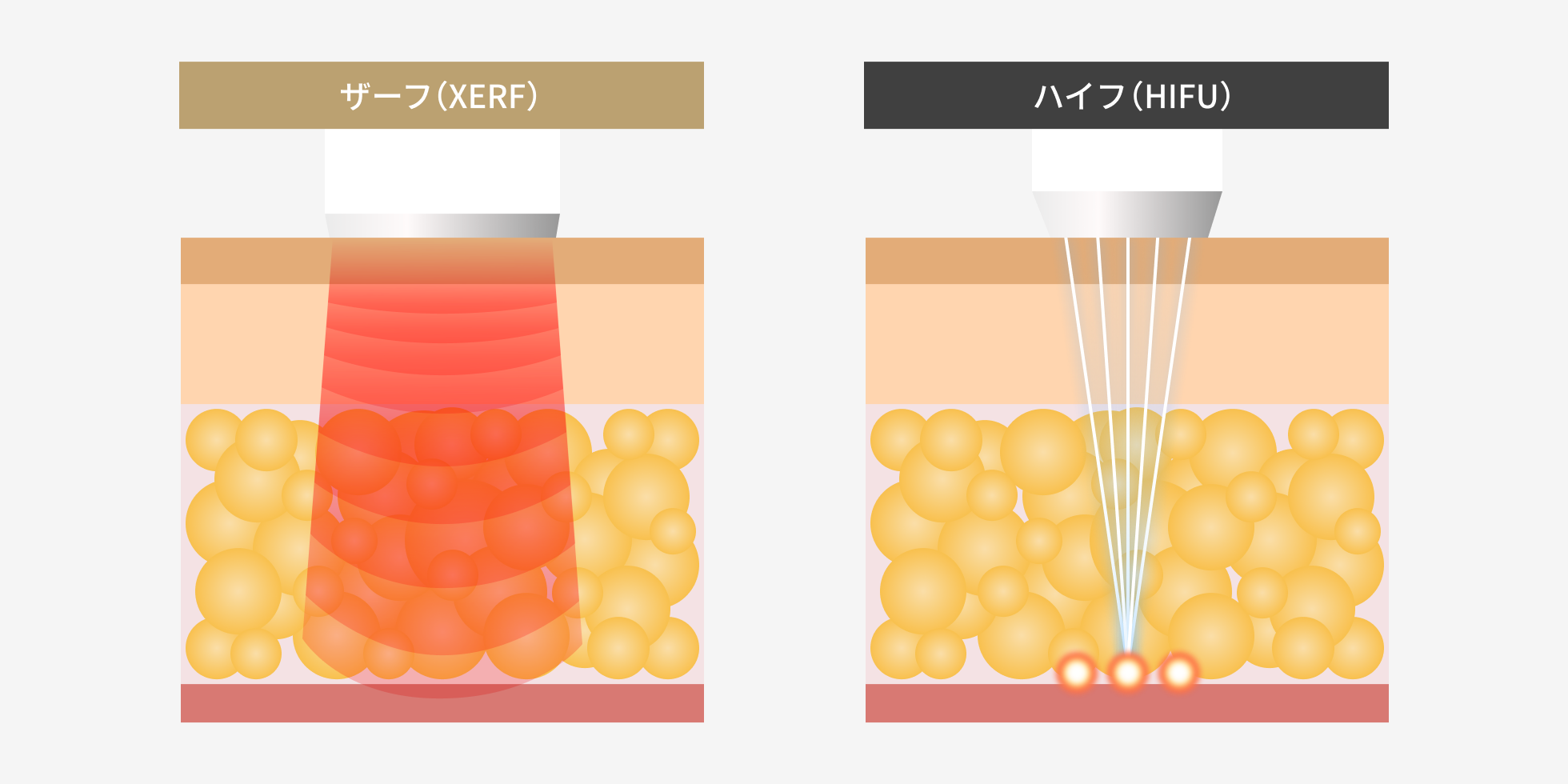 ザーフ（XERF）とハイフ（HIFU）の熱の入り方の違い。ザーフは面で広く、ハイフは一点に集中して熱を届ける
