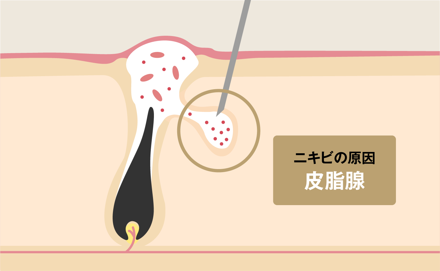 ニキビの原因皮脂腺