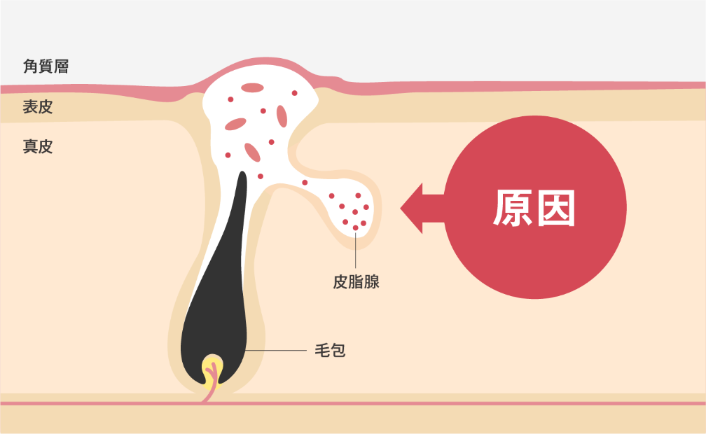 ニキビの原因